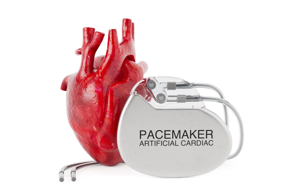 Can You Do CPR on Someone with a Pacemaker? 5 Critical Steps