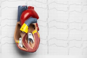 CPR on someone with a pacemaker